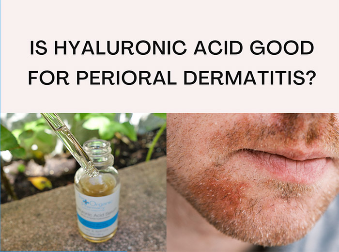 The latest on Green Beauty Talk: Is Hyaluronic Acid Good for Perioral Dermatitis? What do you think? I've done all the research and here are my findings: greenbeautytalk.com/is-hyaluronic-… #hyaluronicacid #dermatitis #bbloggers