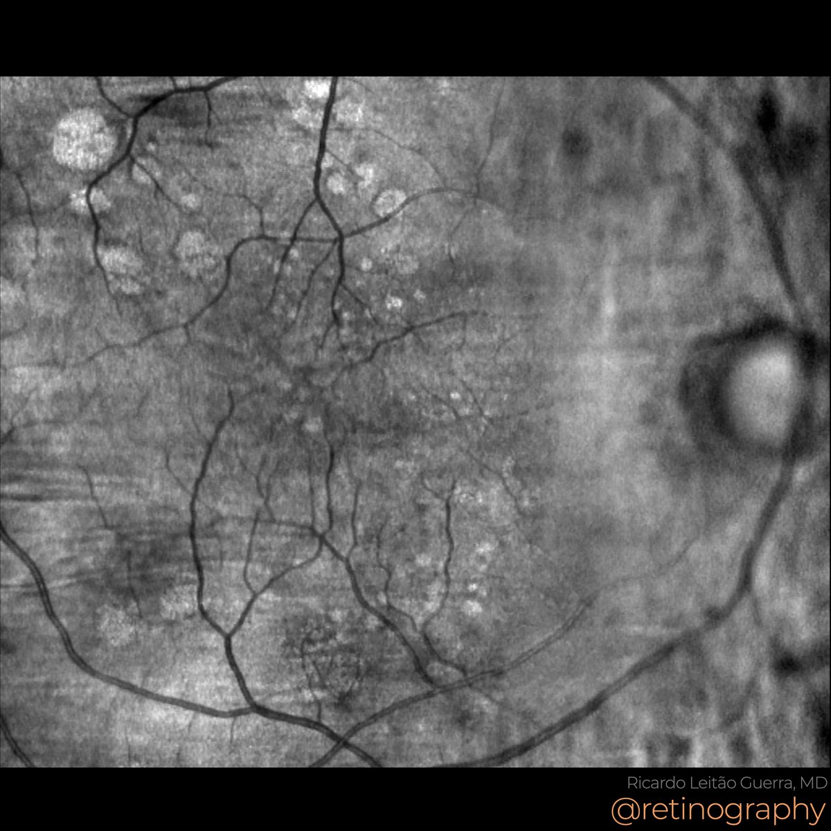 CHRPE has unique features on fundus autofluorescence and near-infrared reflectance imaging, providing valuable diagnostic insights.
