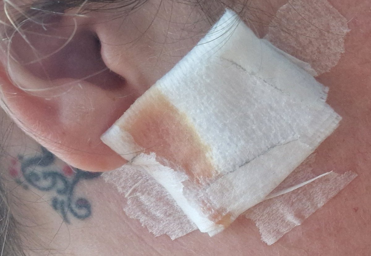 Just my luck! 😫 I turned up yesterday to start my first shift of a new job, feeling dizzy, a bit of a leaky ear. Manger, so understanding, sent me home. Today, the start date has been pushed back a week. Turns out I have a perforated eardrum 😫 I've never perforated my eardrum!!
