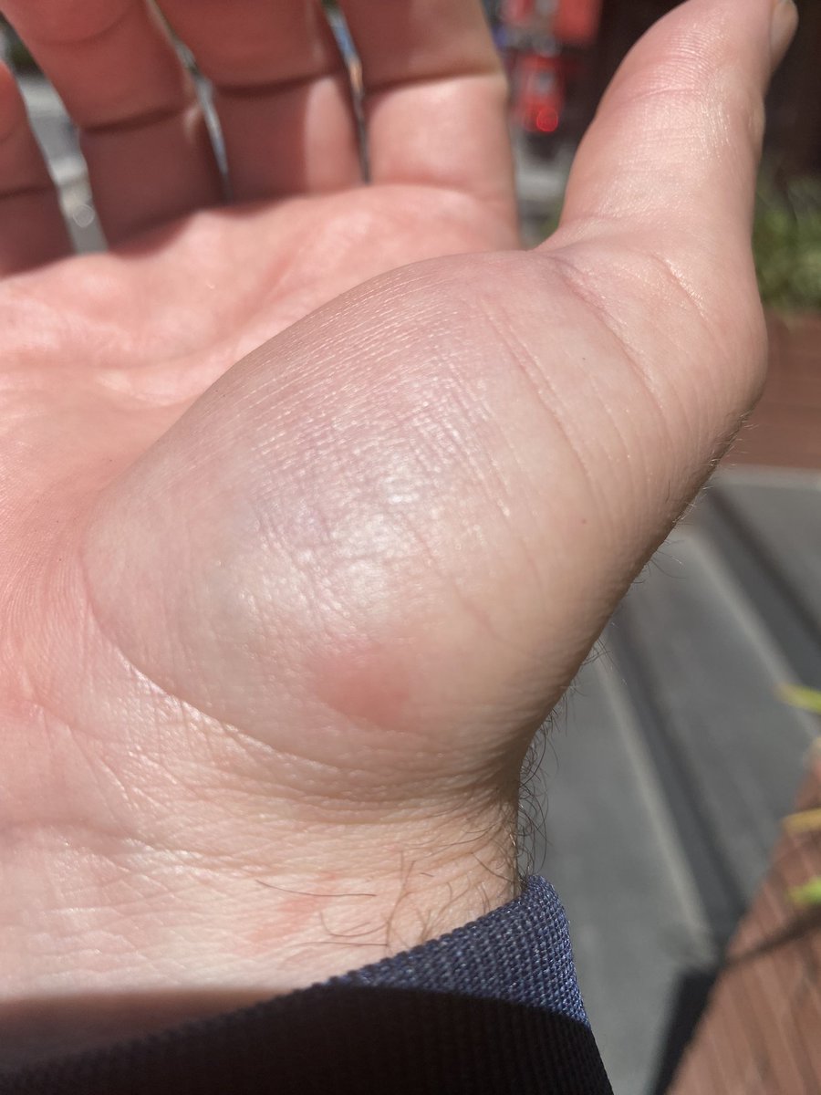 Spiderbite? on my hand