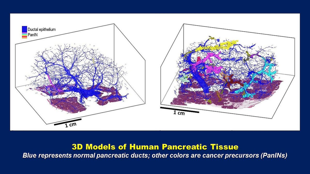 Study led by @JHUPath in @Nature (rdcu.be/dGpnV): Extensive 3D analysis of human pancreas shows tiny precancers - PanINs - common in normal organs, multifocal & w/ heterogeneous gene mutations. @lauradelongwood @deniswirtz @AshleyKiemen Alicia Braxton @Hopkins_GI_Path