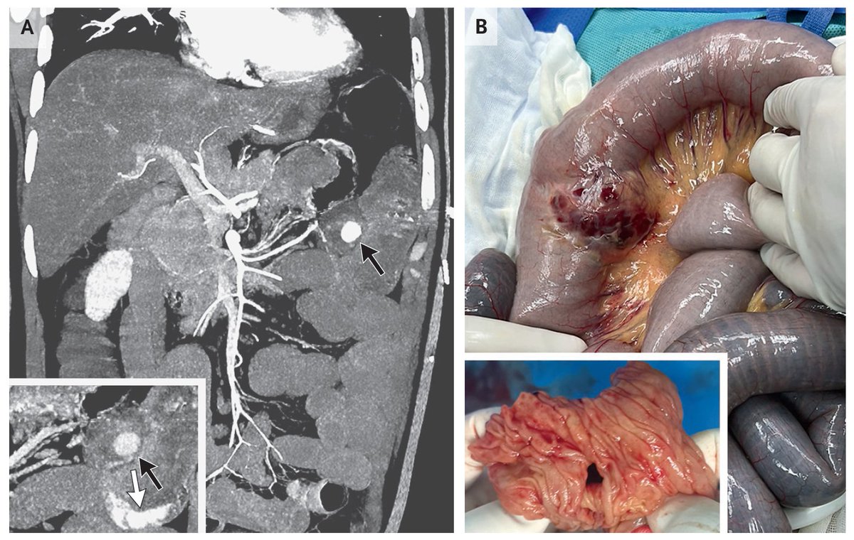 Images in Clinical Medicine: Small-Bowel Bleeding nej.md/3JDbZjv #Surgery #Gastroenterology