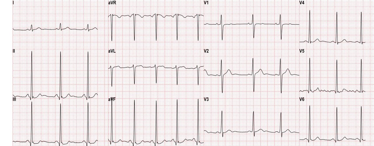 18 yo male, no complaints, no HX of any cardiac disease; could be normal, couldn`d it?