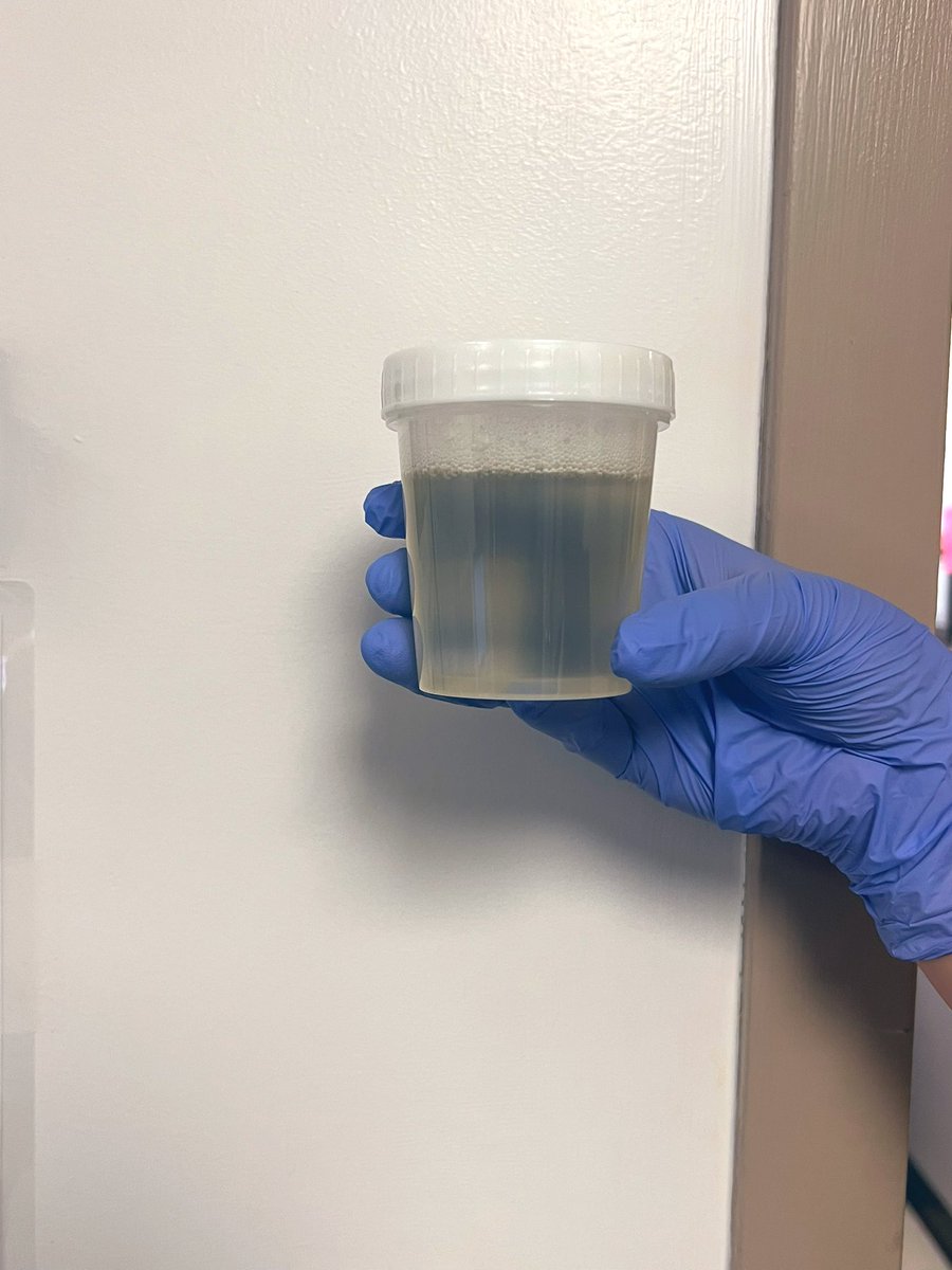 The patient has been diagnosed with IgAN, and this is the urine sample. What do you estimate the proteinuria to be? I'm usually pretty accurate with a standard deviation of ±0.5! 🤓#nephtwitter #MedTwitter