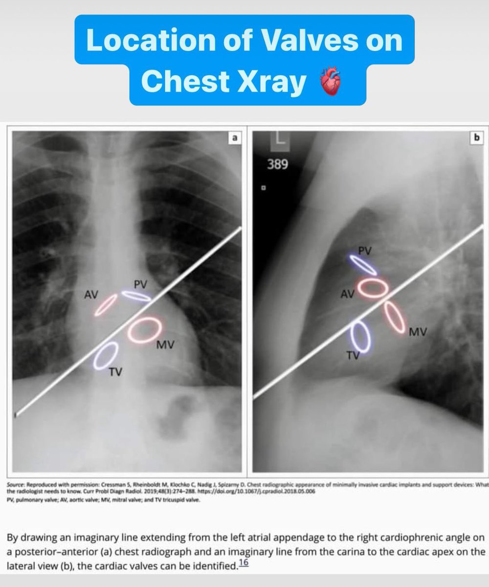 #BacktoBasics Can we identify the cardiac valves on chest Xray? 

Simple strategy of drawing an imaginary line from the LAA to the right cardiophrenic angle 📐👇