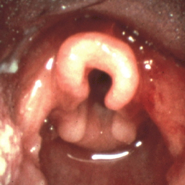 🗣️:🇺🇸/🫂:👨‍⚕️🩺
Flexible bronchoscopy demonstrated ⤵️
The baby is happy while sleeping [... (supine/prone)].