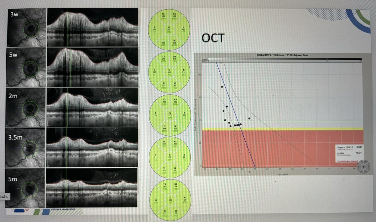 Dr Susan Mollan (@drmollan) on Twitter photo #IIH has a Clear diagnostic pathway to exclude #CVST and #anaemia <a href="/MarkHeadache/">Mark</a> <a href="/IIHUK/">IIH UK</a> <a href="/BrainLabBhamUk/">Translational Brain Science Research Birmingham UK</a> <a href="/ABNTrainees/">Neurology Trainees</a> <a href="/neurochecklists/">Neurochecklists</a> <a href="/EHF_Official/">European Headache Federation</a> #EHF future headache experts meeting. Great case based approach jnnp.bmj.com/content/89/10/… #IIH has a Clear diagnostic pathway to exclude #CVST and #anaemia <a href="/MarkHeadache/">Mark</a> <a href="/IIHUK/">IIH UK</a> <a href="/BrainLabBhamUk/">Translational Brain Science Research Birmingham UK</a> <a href="/ABNTrainees/">Neurology Trainees</a> <a href="/neurochecklists/">Neurochecklists</a> <a href="/EHF_Official/">European Headache Federation</a> #EHF future headache experts meeting. Great case based approach jnnp.bmj.com/content/89/10/…
