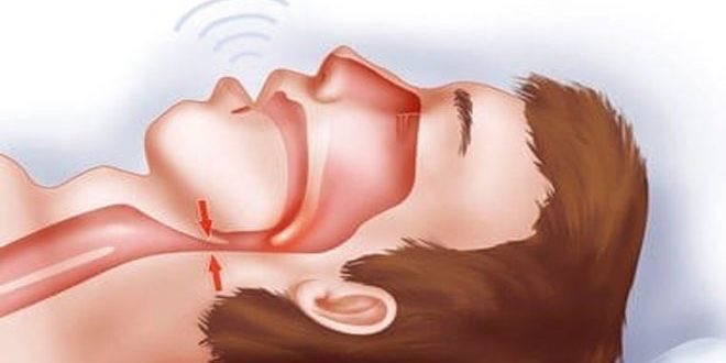 ما هو انقطاع التنفس في أثناء النوم؟😴
يعد من أحد اضطرابات النوم شديدة الخطر حيث يتوقف التنفس أو ينخفض بشكل متكرر لفترة طويلة ويؤدي ذلك  إلى الاستيقاظ من النوم. وهذا التوقف المتكرر يؤدي إلى نقص في مستويات الأكسجين وزيادة في مستويات ثاني أوكسيد الكربون في الدم.
#انقطاع_التنفس