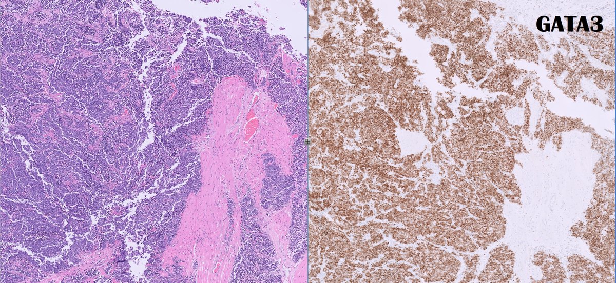 #GUpath TURBT🧩time!

middle-aged M, no priors, presents with hematuria, TURBT performed

🤨❓🔬