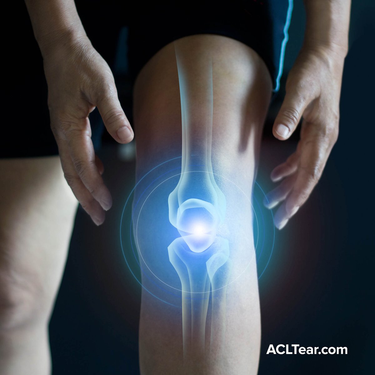 Overcome your ACL injury and get back to the activities you love. Connect with a surgeon in your area to find out which Arthrex Knee Preservation procedure is right for you: arthrex.info/4bn3lBr

#Arthrex #Orthopedics #MedicalEducation #ACLTear #Knee #ACLInjury