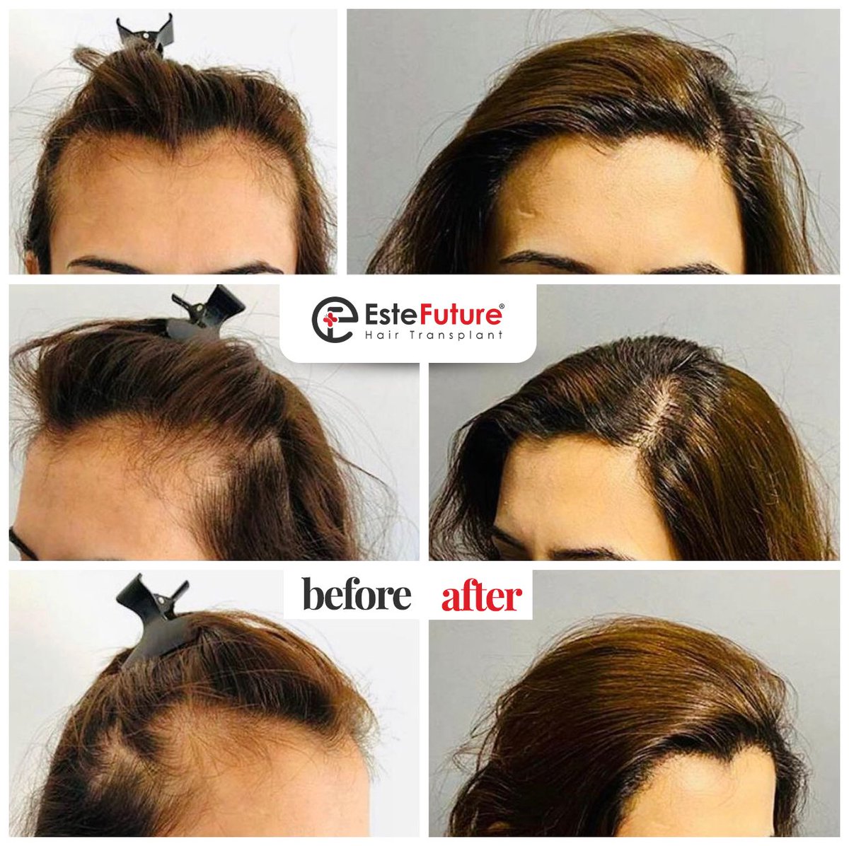 Restore the strength in your hair! We are here for an effective solution against hair loss. 💇‍♀️ #HairPlant #StrongHair #estefuture #hairtransplant #beforeafter