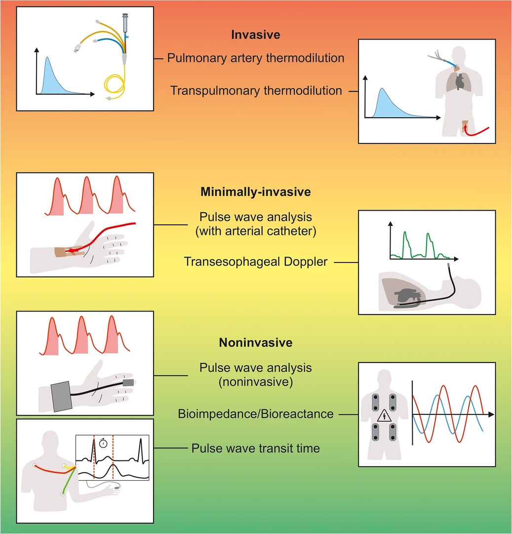 Haemodynamic monitoring during noncardiac surgery: past, present, and future CCR Journal Watch criticalcarereviews.com/latest-evidenc… Get the latest critical care literature every weekend via the CCR Newsletter - subscribe at criticalcarereviews.com/newsletters/su…