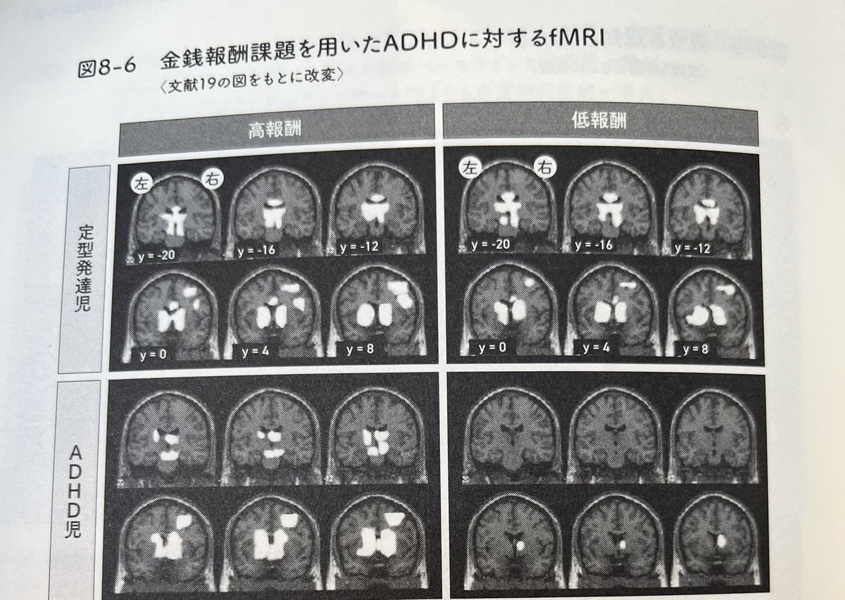 「ADHD児はわくわくしない課題では脳が動かない」という先日つぶやいたものの根拠となる論文から作られたものです。