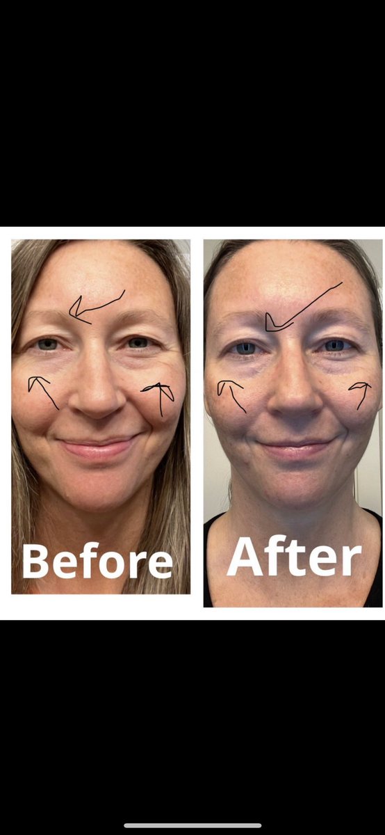 SHOP NIRA LASER & Look younger in 90 days! Or your $ back! USE CODE: LADYBOARDER 4 Extra savings! #WRINKLES MY 90-day B4 & AFTER! #NIRATRIBE #antiaging #antiaginglaser #youthfulskin #healthyhabits #youngerskin #finelines #crowsfeet #lookyounger bit.ly/37H84m5 AD