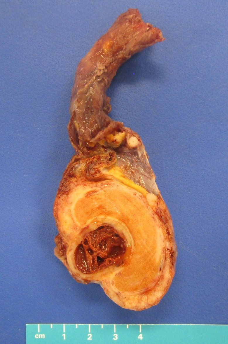 He earned the gross photo of the quarter certificate AGAIN! @MalekAsfar, PGY3 @MhPathology. Hematoma in a testis. Congratulations, Malek and keep up those photo skills!

#pathology #pathtwitter #pathresidents #grosspath #grossphotography