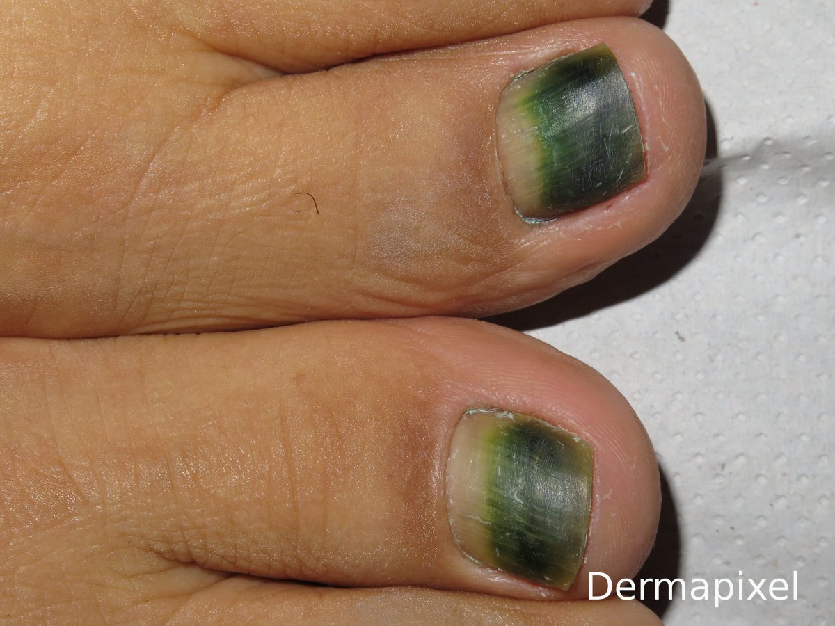Uñas verdes 💅💚: pensad en Pseudomonas. Esta semana en @dermapixel.
dermapixel.com/2024/05/color-…
#dermatología