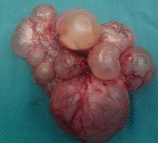 Nephro18's tweet photo. 1️⃣Multicystic Dysplastic Kidney (#MCDK)
📍Rare, affects 1 in 4,300 fetuses
📍 characterized by non-communicating renal cysts and is classified in a group of congenital disorders termed congenital anomalies of the kidney and urinary tract (CAKUT).
📍 Caused by pathogenic variations of certain genes, such as TCF2 and PAX2 and mutations involving uroplakins.
📍 MCDK morphogenesis can range from cystic formations to hydronephrotic changes
📍Bilateral MCDK is often associated with a congenital cause, whereas unilateral is sporadic.