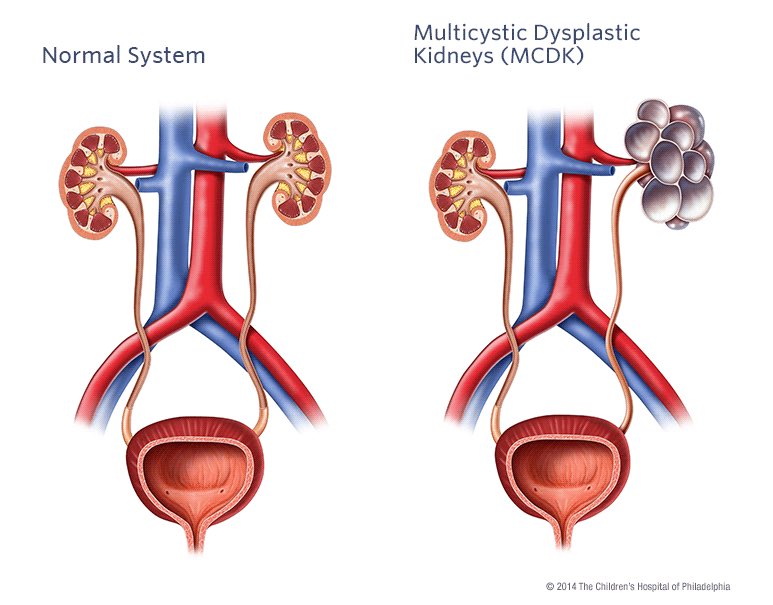 1️⃣Multicystic Dysplastic Kidney (#MCDK) 

📍Rare, affects 1 in 4,300 fetuses
📍 characterized by non-communicating renal cysts and is classified in a group of congenital disorders termed congenital anomalies of the kidney and urinary tract (CAKUT).
📍 Caused by pathogenic…