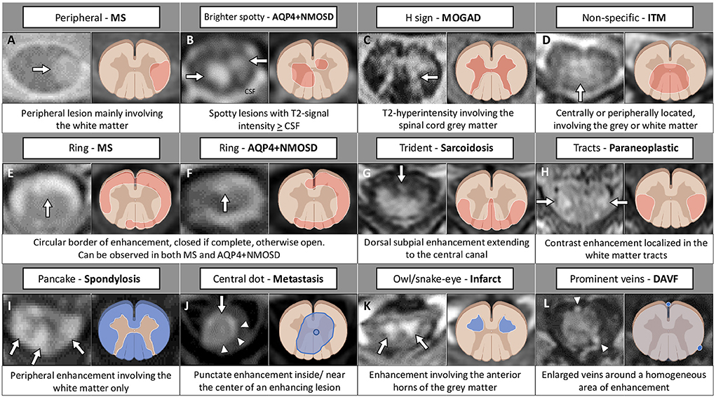 Neuroimaging features in inflammatory myelopathies: A review. doi: 10.3389/fneur.2022.993645