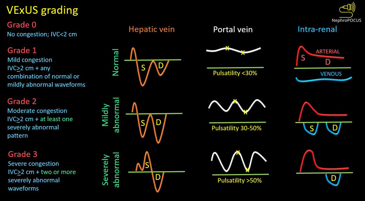 2/ ☝️images show a dilated inferior vena cava with an approximate anteroposterior diameter of 3 cm, systolic reversal in the hepatic vein flow, and a pulsatile portal vein with some flow reversal. Even without intrarenal waveform, it's #VExUS grade 3 (also, IRVD is not