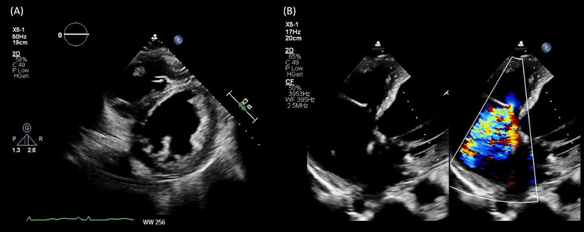 3/ Of note there was no pedal edema or shortness of breath. A 👔formal #echocardiogram was ordered - reduction of LVEF from a baseline of 37 to ~30%, new right ventricular enlargement with interventricular septal flattening (D-sign) and severe functional tricuspid regurgitation