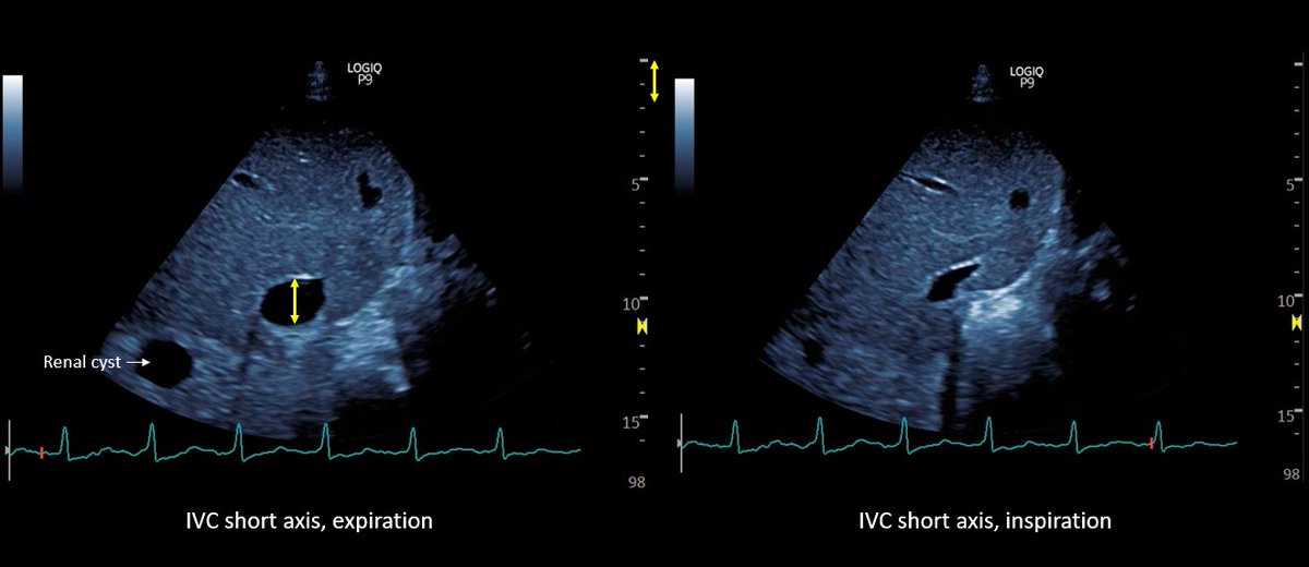 5/ Follow up #POCUS after the 3rd session demonstrated further improvement in IVC size (<2 cm) and collapsibility. 
Remarkably, the shape of the IVC shifted from circular to oval during the decongestion of the patient, a clinically useful qualitative parameter. 
Hepatic vein…