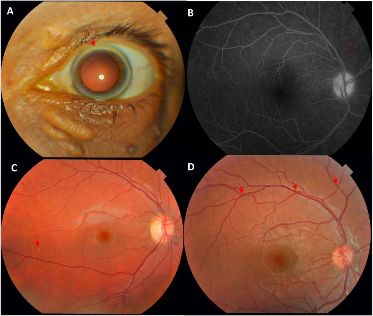 New paper Labor of love from Lebanese Familial Hypercholesterolemia Registry, developed while still Med student many years ago! Ocular Manifestations of Severe FH - Corneal arcus - Xanthelasmas - Retinal Vascular Abnormalities cell.com/heliyon/fullte… Collab w/ @AUB_Lebanon