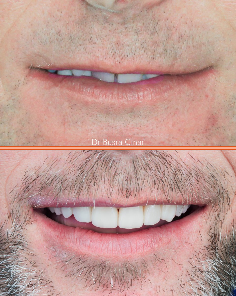 See the magic of transformation at 3Dental Galway! ✨ A radiant smile that mirrors renewed self-esteem - all possible owing to Dr. Cinar's expertise. #ReinventYourSmile #SmileMakeover #AffordableDentalCare #3DentalMagic