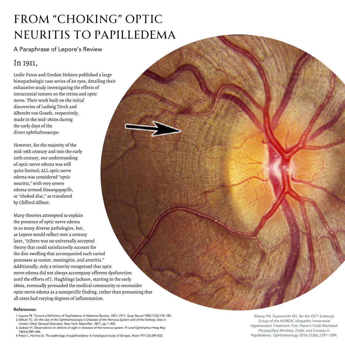 This one’s an exercise in spacing and arrangement. I chose the circular frame to mimic the view from a direct ophthalmoscope. Image is from the IIHTT, used for educational purposes. #ophthalmology #neuroophthalmology #neurology