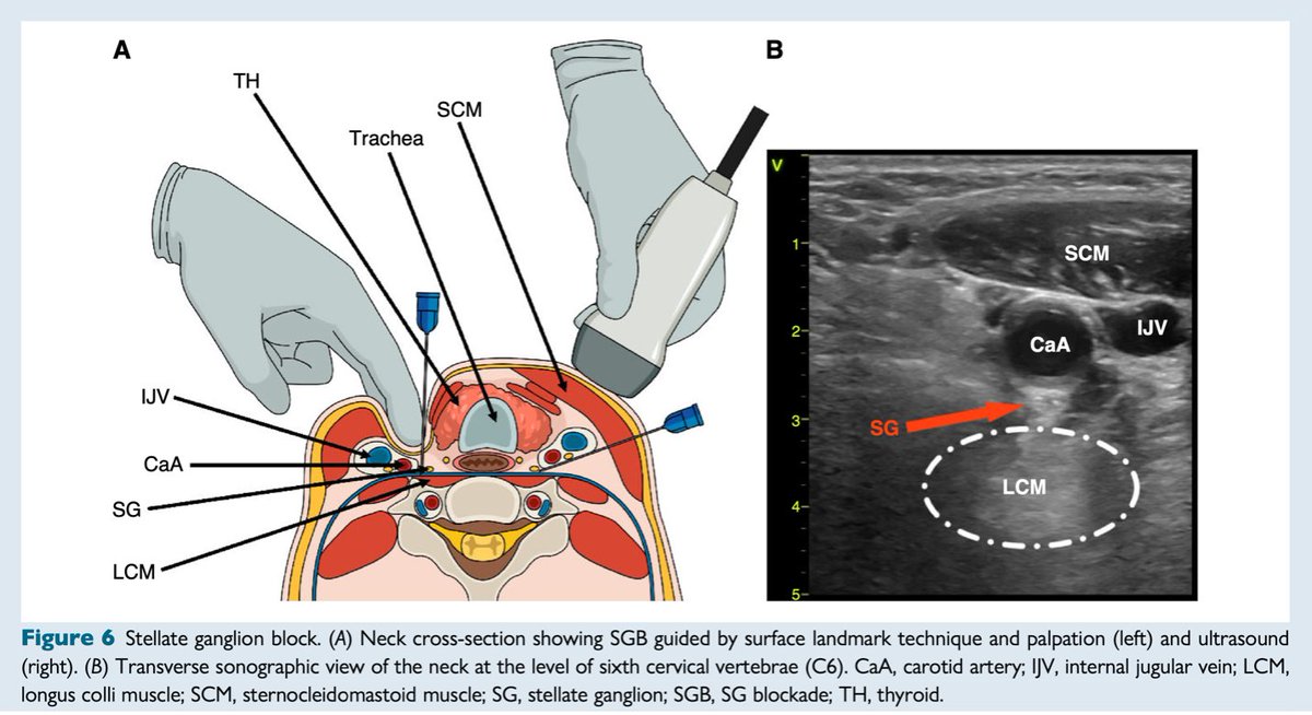 #EHRAtopicweek on electrical storm⚡ What to do when amiodarone and propranolol fail and catheter ablation is not feasible? Stellate ganglion block may be helpful. Read more #Europace doi.org/10.1093/europa… @EuropaceEIC