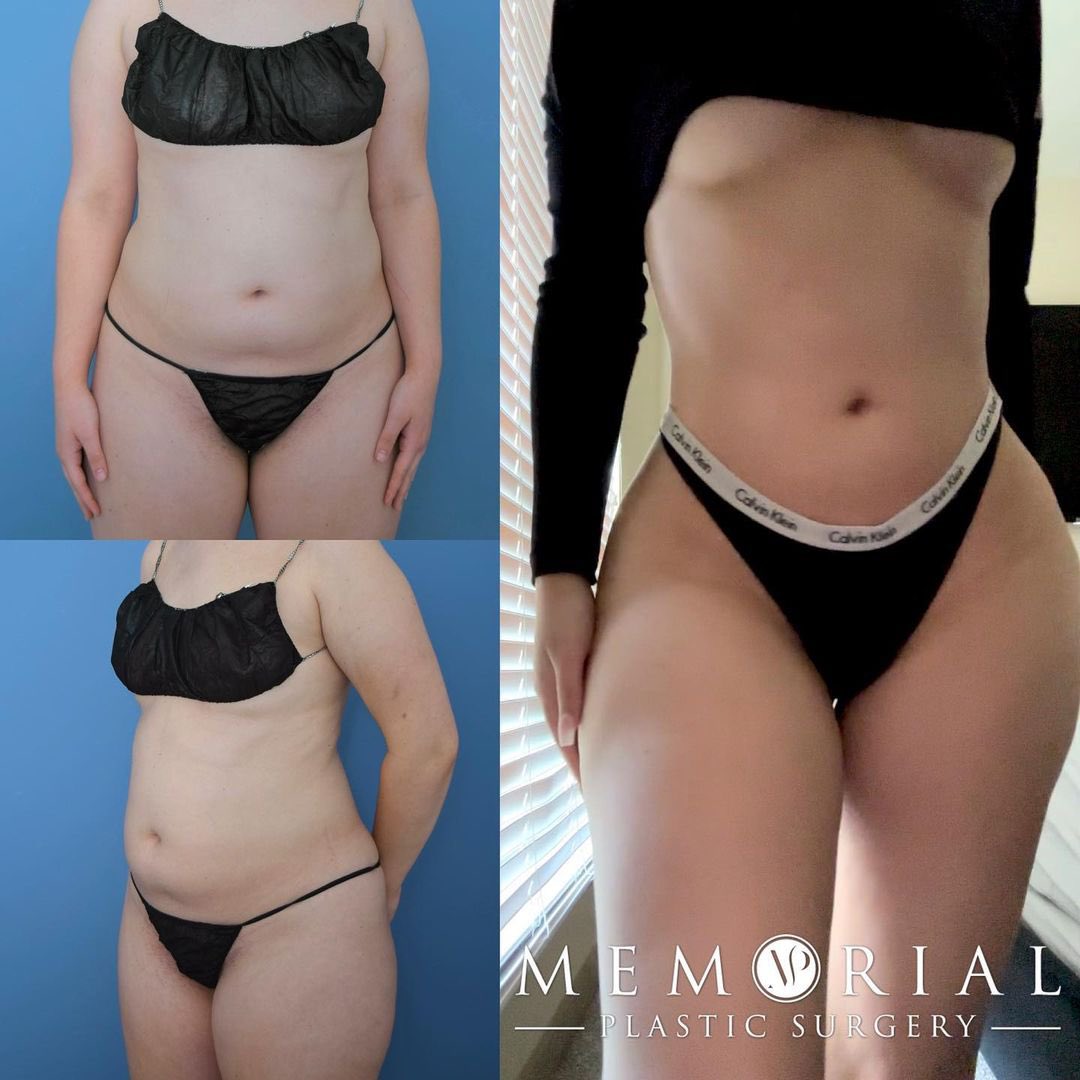 Beautiful body shape by Dr. V 🤩 She is over 1 year post-op from her surgery date and is doing an amazing job at maintaining her results 👏

Procedure: #BBL + #Lipo360 🔥
(Pre-Sx: Wt: 180 lbs Ht: 5’6 BMI: 29)

#newbody #transformation #beforeandafter #houstonplasticsurgeon