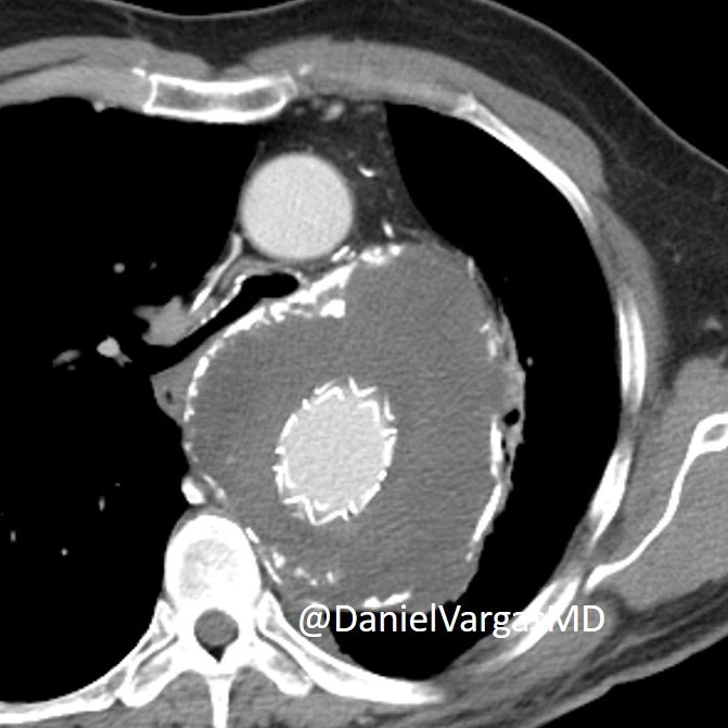 CT and answer to this case: Post endovascular repair for massive aortic aneurysm with an 👀aorto-bronchial fistula 👀 (involving the excluded aortic aneurysm) CT showing air filling the aneurysmal sac. Earlier CT w large aneurysm post endovascular repair.