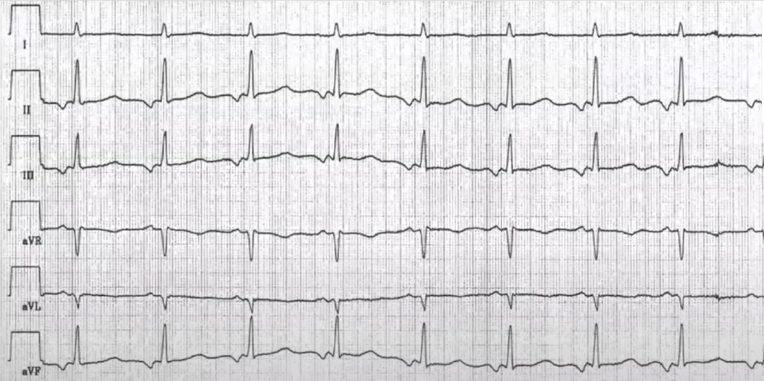 Passend zum #youngestDGK EKG Kurs in Dresden, habt ihr auch hier wöchentlich die Möglichkeit EKGs zu befunden! 

Zielgruppe sind alle die, die noch keine habilitierten Elektrophysiologen sind und am Anfang ihrer kardiologischen Laufbahn stehen. 😉

#youngestDKG #youngDGK #Epeeps