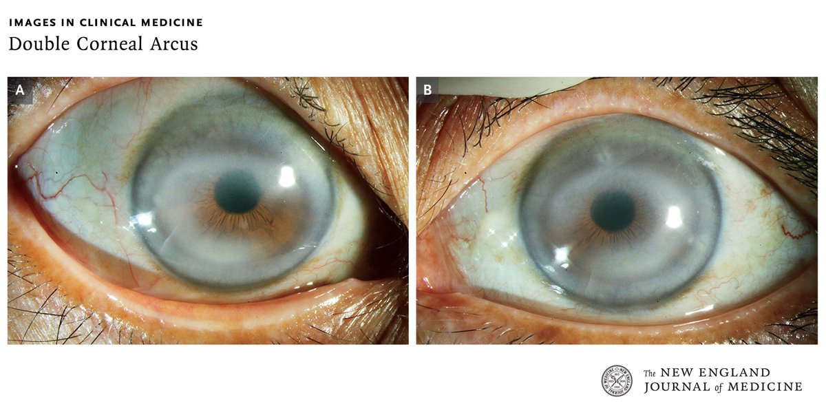 A 63-year-old woman was noted to have white-yellow rings in both eyes. On slit-lamp examination, two concentric rings were seen in each cornea. Read the full clinical case: nej.md/3Uk5l6p