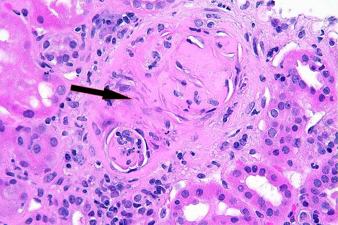 Physical features seen on the images 👇 Renal biopsy 👇 Fatigue weight loss Rhinitis Hemoptysis Hematuria. Positive ANCA Diagnosis? Complications? Differential diagnosis? Treatment? #MedX #MedEd #Medical #MedTwitter #FOAMed #medicine #NEET #clinical #rheuma…