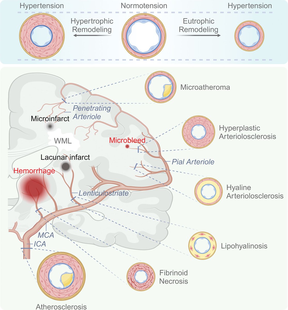 CENTENNIAL REVIEW: Hypertension, Neurodegeneration, and Cognitive Decline ahajrnls.org/49ZYFQP