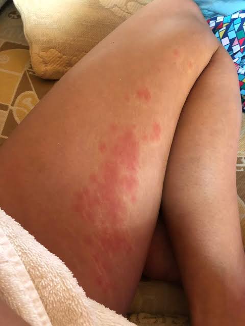 What causes these red spots on a woman's thighs, and what's the cure?