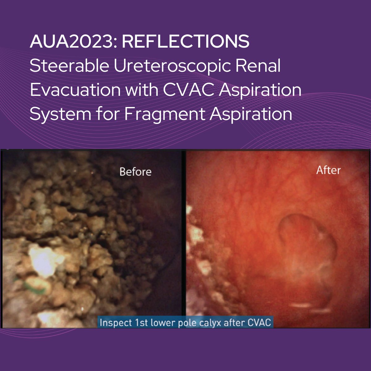 🔬 Reflecting on #AUA2023, we're proud of the recognition our #CVAC Aspiration System received for its impactful innovation. As we look ahead, anticipate groundbreaking advancements from us at #AUA2024. Explore our journey: auanews.net/issues/article… #CalyxoCVAC #Urology…