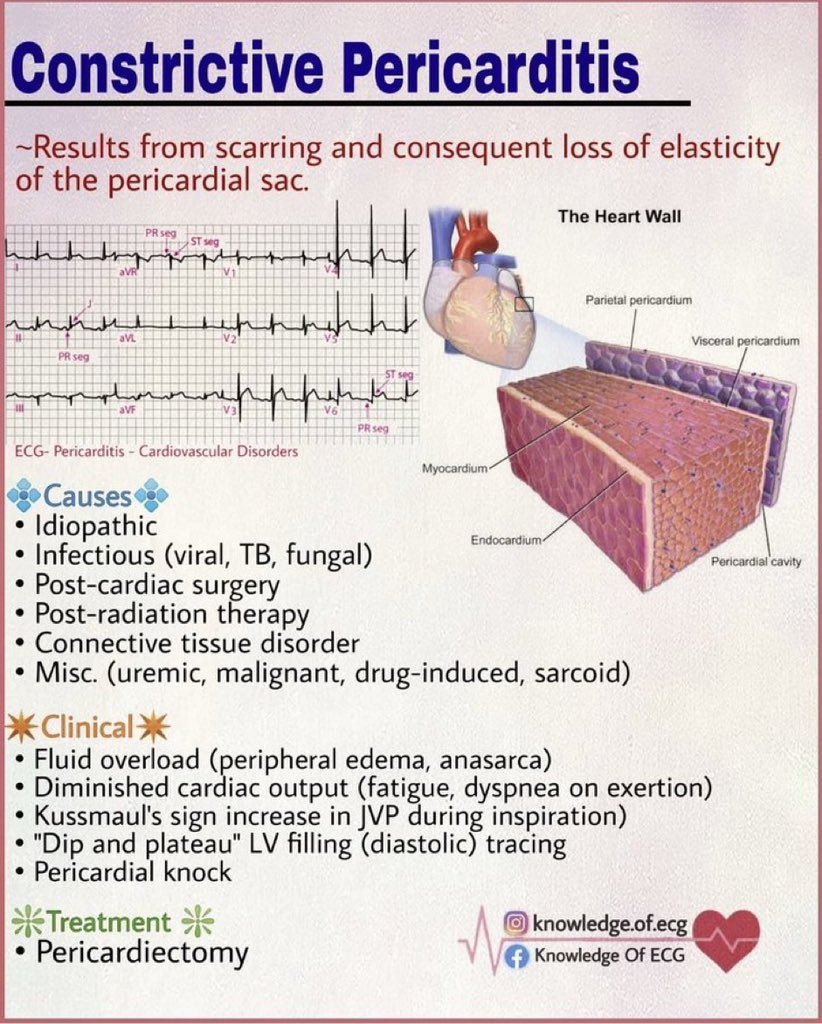 Constructive pericarditis

H/t @TLHM_MD #Meded #MedX #cardioEd #Cardiology #CardioTwitter