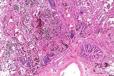 Study of f 234 AAV pts. 85 (36%) developed diffuse alveolar haemorrhage. Independent predictors of DAH: 1) Age [OR=1.037); 2) PLT # [OR=0.996]; 3) ESR [OR=1.028]; 4) HgB [OR=0.978]; 5) hematuria [OR=3.77] buff.ly/3WmDg0R