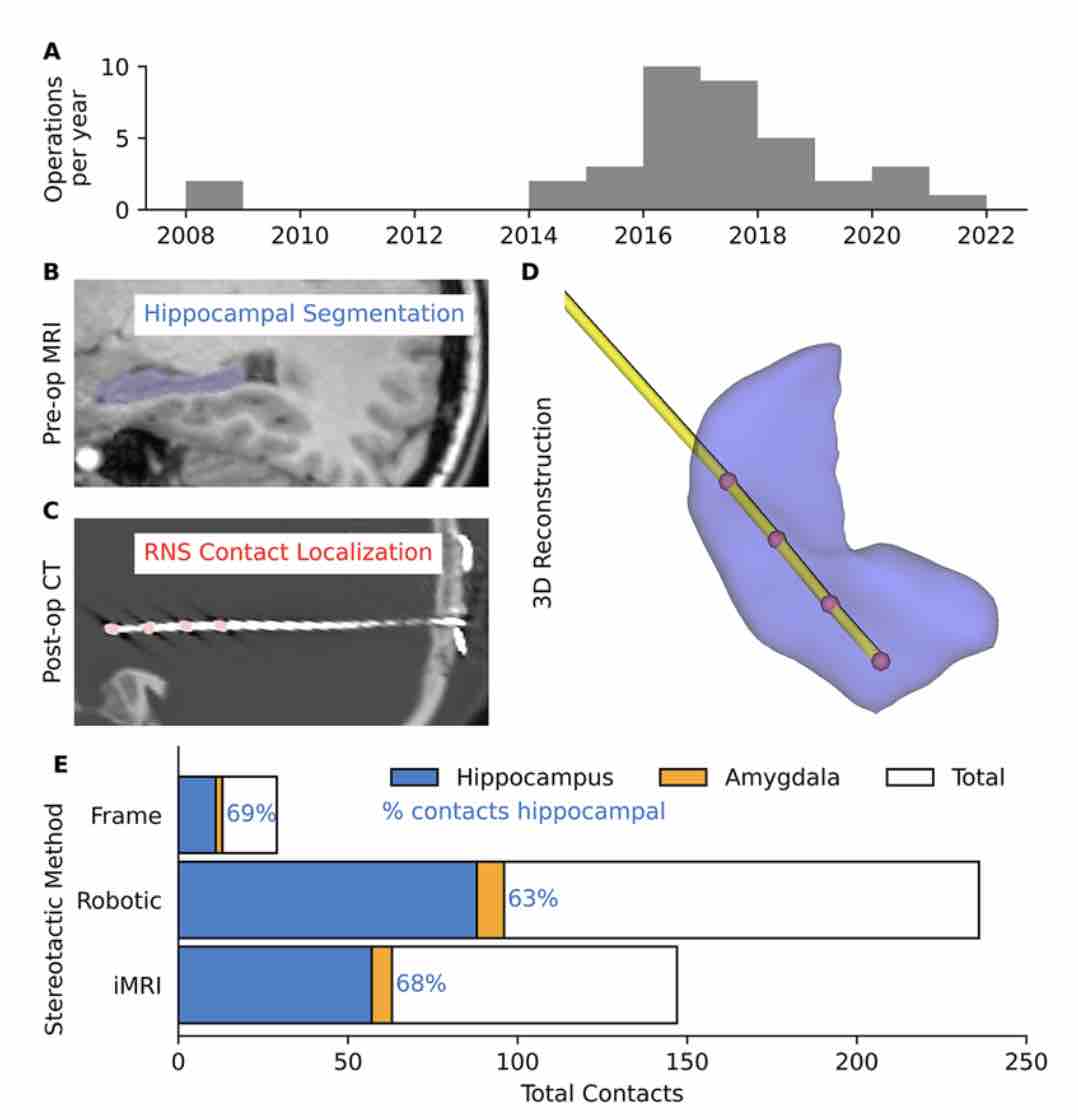 #OnlineFirst: Optimal hippocampal targeting in responsive neurostimulation for mesial temporal lobe epilepsy. thejns.org/view/journals/….