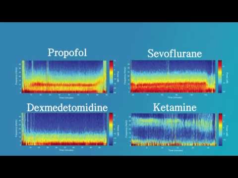 #BoardThings: While BIS can be used to monitor anesthetic depth, some meds cause artificial changes due to abnormal EEG signatures: - N2O/ketamine can artificially ⬆️ BIS - Precedex can artificially ⬇️ BIS More: m.youtube.com/watch?v=K2dMqs… #MedTwitter #MedEd #FOAMEd #Anesthesiology