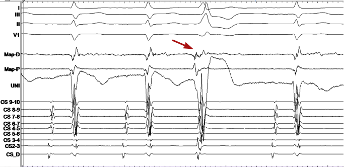 Ablation site #epeps  RCC-LCC PVCs .  look for this potential @epeeps