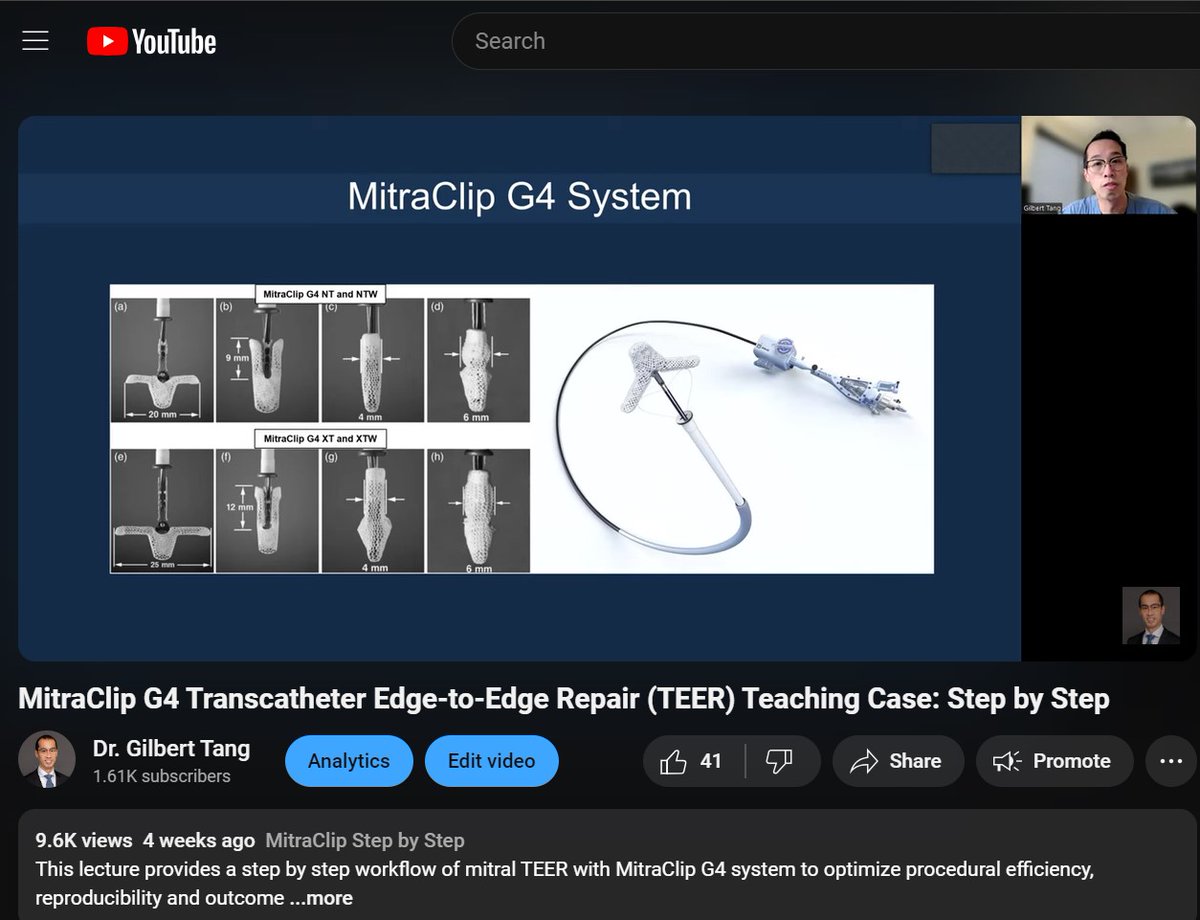 WOW! 9700 views & counting! Thank U for making my M-TEER #MitraClip step-by-step video on my @YouTube channel my highest viewed video! Now translated into Chinese for MitraClip G4 launch in China! Let's aim to cross 10k views in May! @AbbottCardio youtube.com/watch?v=XiBNAE…