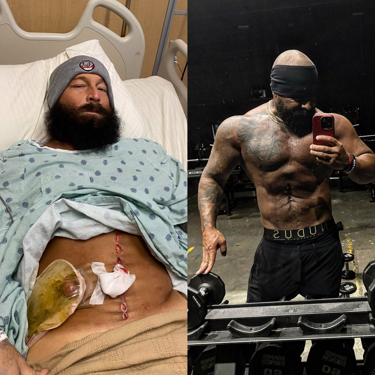 @KennyOmegamanX if you happen to see this.... This is a Total Colectomy / J Pouch 3 years in between photos and 5 total surgeries, but it's possible to come back and do what you love. @AEW
