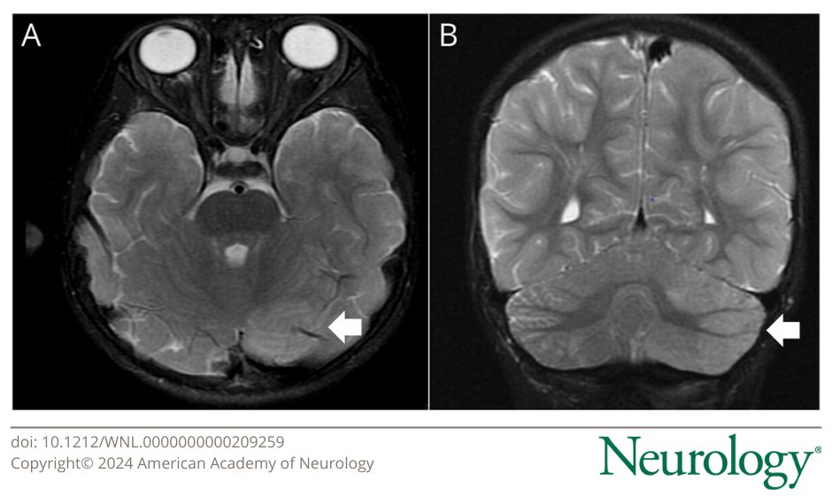A 2-yo girl presented with 2 wks of seizures, left-sided chorea, ataxia, and behavioral/speech regression. MRI of the brain revealed cerebellitis with negative evaluation for paraneoplastic, metabolic, and infectious etiologies. Learn more: bit.ly/3TXoxrQ #NeurologyRF