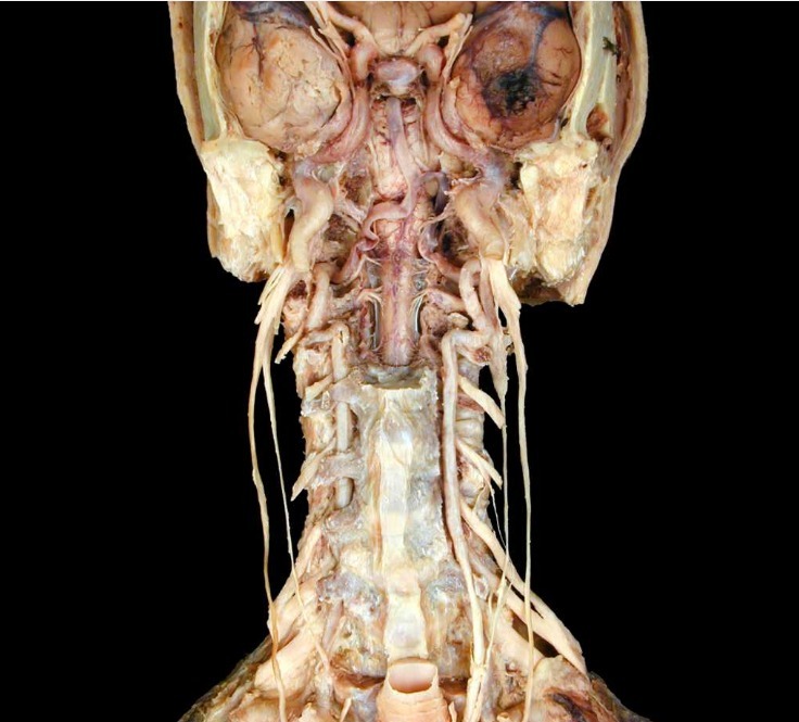Internal carotid and vertebral arteries - anterior view
