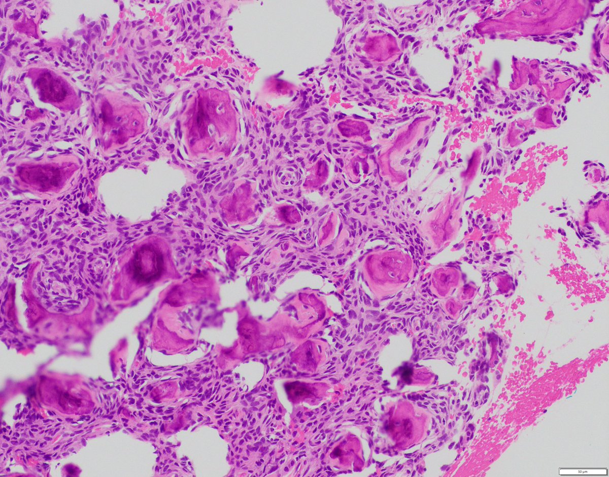 A tricky paranasal sinus bone mass in a child…what are some differential diagnoses based on histology? 🤔

#pedipath #neuropath #bonepath #pathology