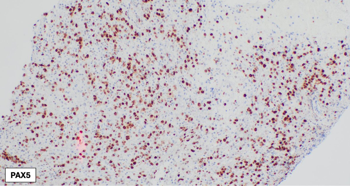 SibaElHussein's tweet image. Primary large B-cell lymphoma of the CNS: Cyclin-D1 highlights endothelial cells in brain tissue, however its pattern of expression could be  misinterpreted as positivity in neoplastic cells. Comparison to MUM1 &amp;amp; PAX5 is helpful to avoid this pitfall #hemepath #lymsm #PathX