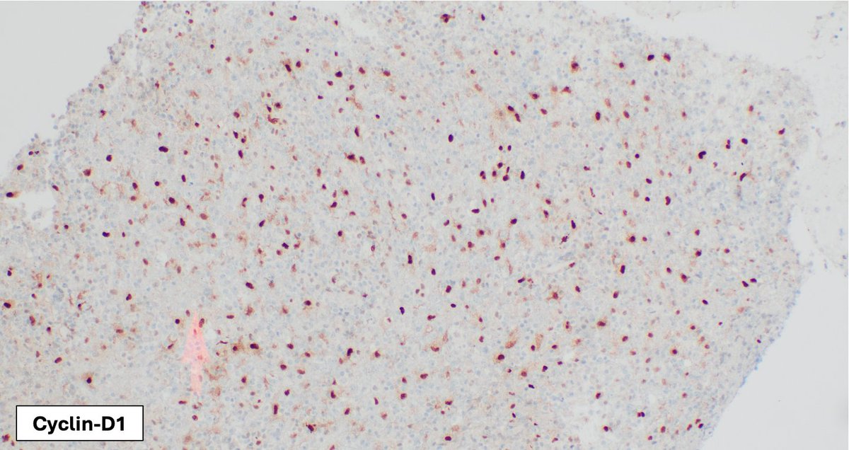 SibaElHussein's tweet image. Primary large B-cell lymphoma of the CNS: Cyclin-D1 highlights endothelial cells in brain tissue, however its pattern of expression could be  misinterpreted as positivity in neoplastic cells. Comparison to MUM1 &amp;amp; PAX5 is helpful to avoid this pitfall #hemepath #lymsm #PathX